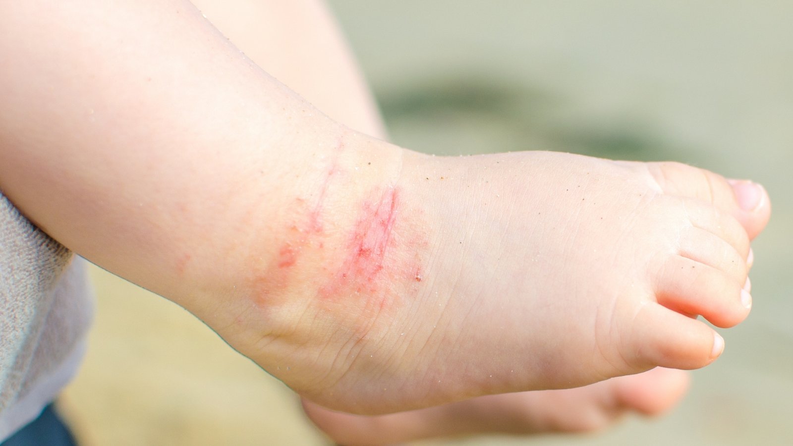 Dermatite Atópica e Alergias de Pele: Cuidado e Prevenção na Infância