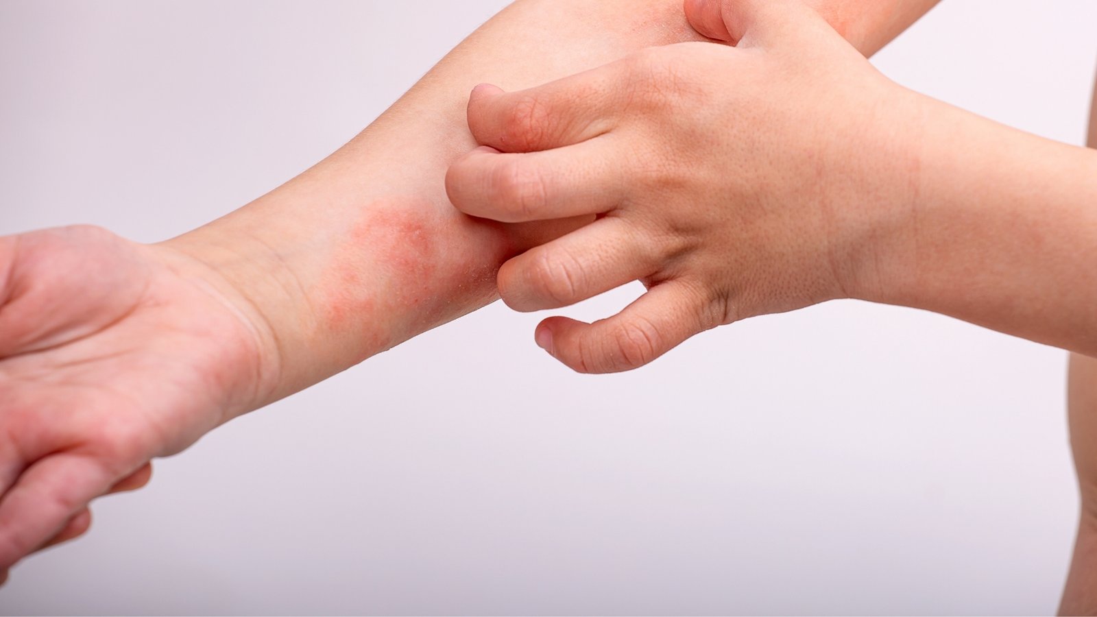 Cuidado com a Pele e Dermatites Pediátricas